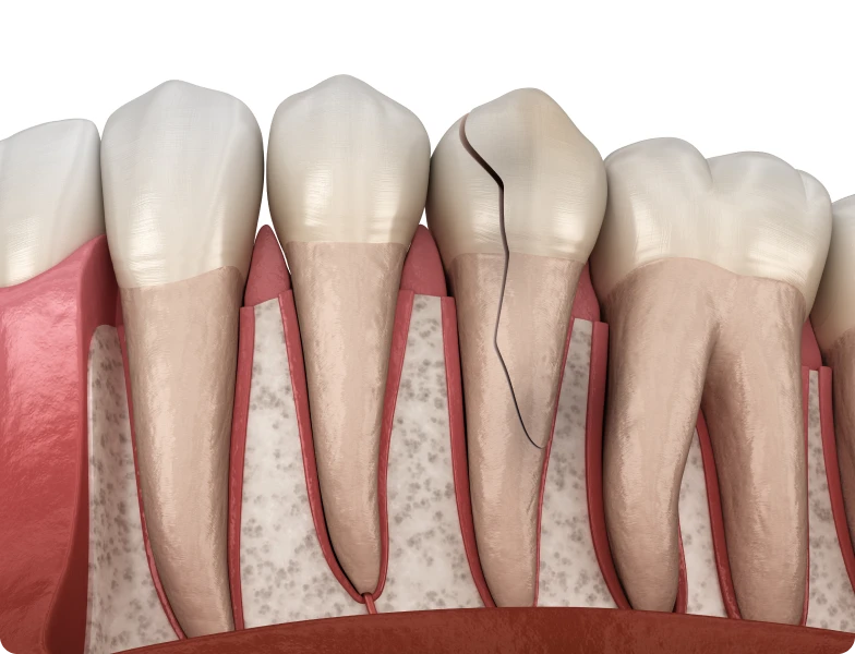 dent fissuree dr simonis strasbourg dent fissuree dr simonis strasbourg Extraction implantation immédiate Extraction implantation immédiate | Dr Simonis | Strasbourg