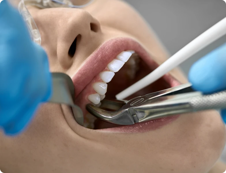 extraction dentaire docteur pierre simonis strasbourg extraction dentaire docteur pierre simonis strasbourg Extraction dentaire Extraction dentaire | Dr Pierre Simonis | Dentiste Strasbourg
