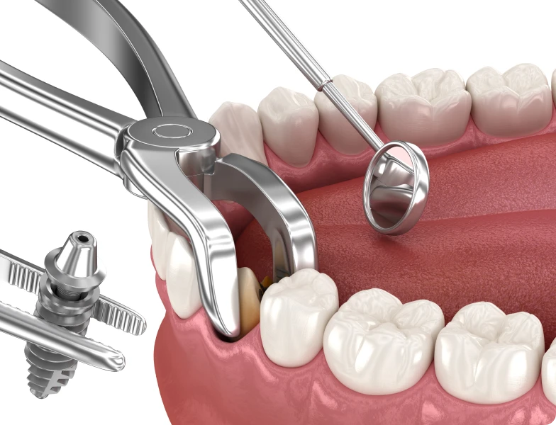 extraction implantation immediate docteur simonis extraction implantation immediate docteur simonis Extraction implantation immédiate Extraction implantation immédiate | Dr Simonis | Strasbourg