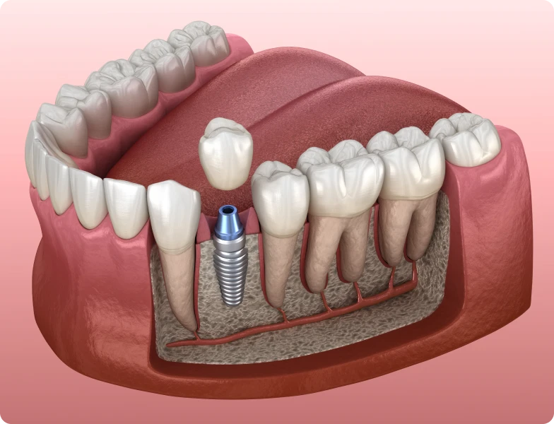 implant dentaire dentiste strasbourg implant dentaire dentiste strasbourg Pose d'un implant dentaire Pose d'un implant dentaire | Dr Simonis | Dentiste Strasbourg