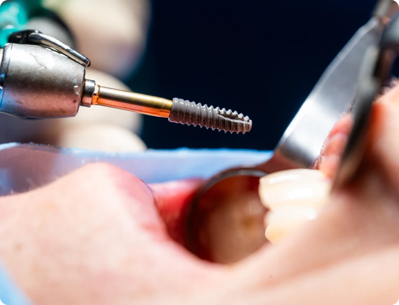 pose implant dentaire dr pierre simonis strasbourg pose implant dentaire dr pierre simonis strasbourg Extraction implantation immédiate Extraction implantation immédiate | Dr Simonis | Strasbourg