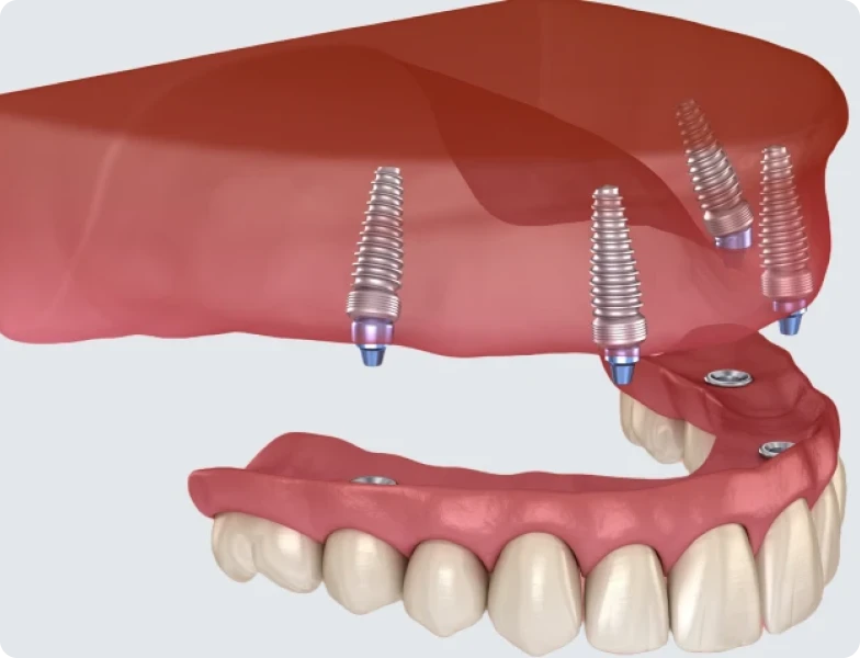 prothese amovible stabilisee par implants prothese amovible stabilisee par implants Prothèse implanto-portée Prothèse implanto-portée | Dr Pierre Simonis | Dentiste Strasbourg