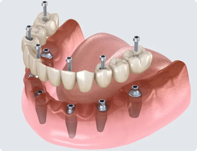 prothese fixe sur implants dentiste strasbourg prothese fixe sur implants dentiste strasbourg Prothèse implanto-portée Prothèse implanto-portée | Dr Pierre Simonis | Dentiste Strasbourg
