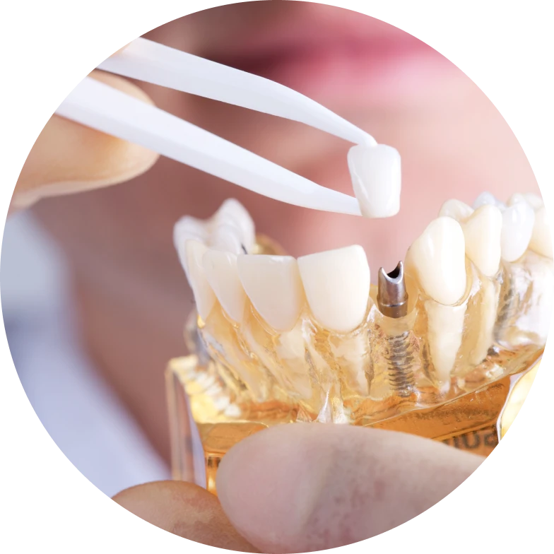 Implant dentaire